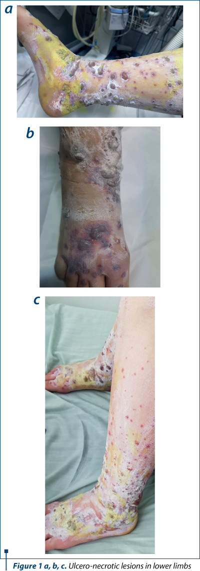 Figure 1 a, b, c. Ulcero-necrotic lesions in lower limbs