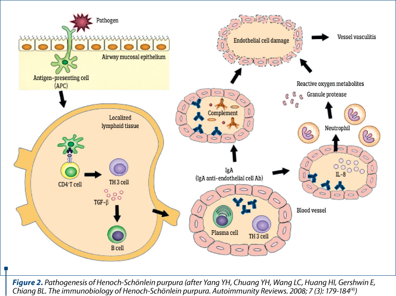 Figure 2. Figure 2. Pathogenesis of Henoch-Schönlein purpura (after Yang YH, Chuang YH, Wang LC, Huang HI, Gershwin E, Chiang BL. The immunobiology of Henoch-Schönlein purpura. Autoimmunity Reviews. 2008; 7 (3): 179-184(4))