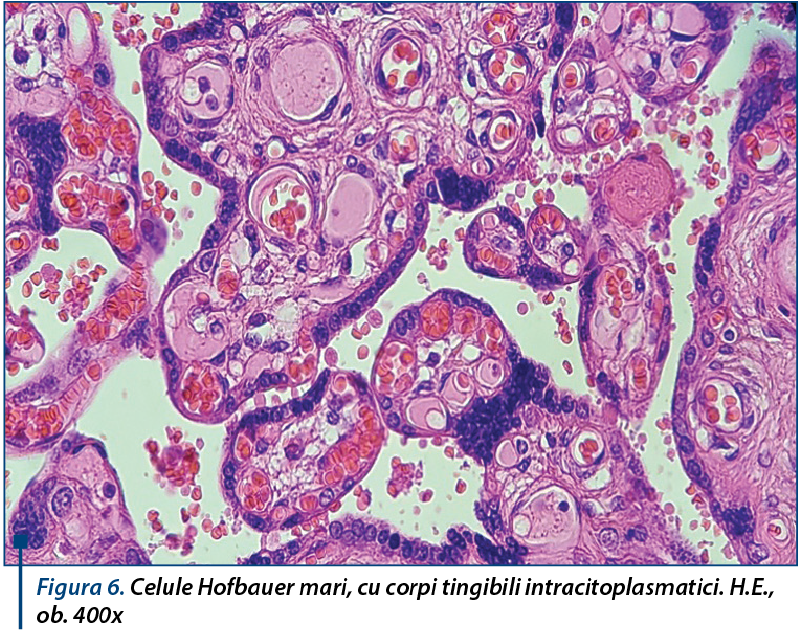 Figura 6. Celule Hofbauer mari, cu corpi tingibili intracitoplasmatici. H.E., ob. 400x