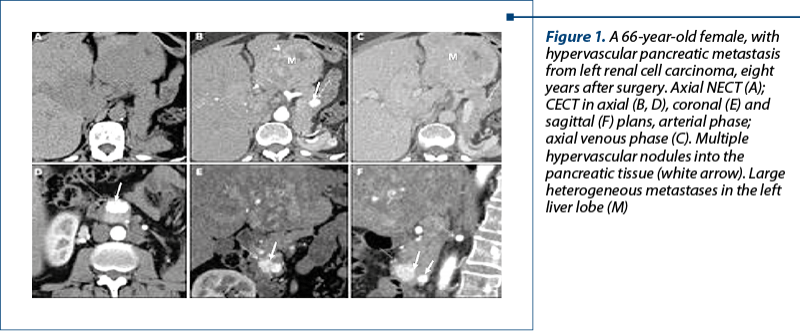Figure 1. A 66-year-old female, with hypervascular pancreatic metastasis from left renal cell carcinoma, eight years after surgery.