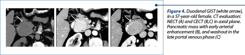 Figure 4. Duodenal GIST (white arrow), in a 57-year-old female.