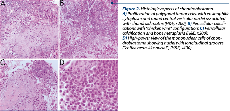 Figure 2. Histologic aspects of chondroblastoma. 