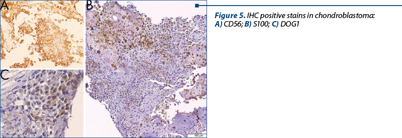Figure 5. IHC positive stains in chondroblastoma