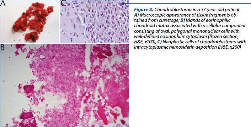 Figure 4. Chondroblastoma in a 37-year-old patient. 