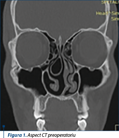 Figura 1. Aspect CT preoperatoriu