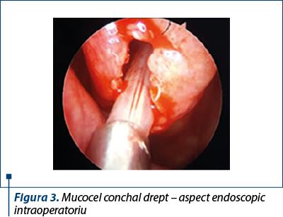 Figura 3. Mucocel conchal drept – aspect endoscopic intraoperatoriu