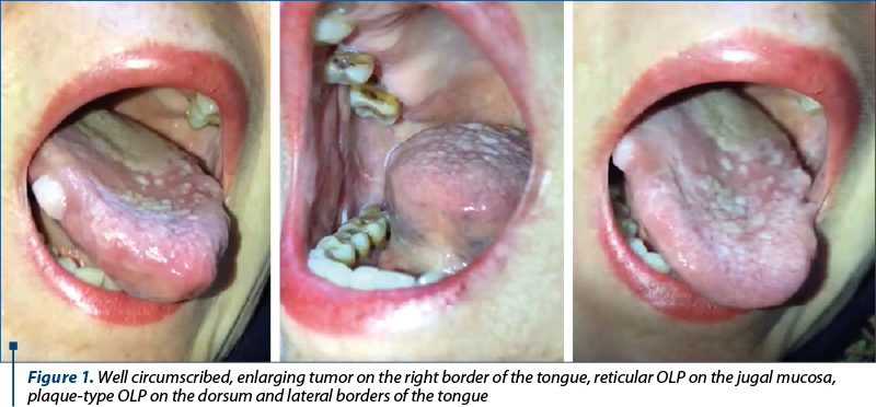 Figure 1. Well circumscribed, enlarging tumor on the right border of the tongue, reticular OLP on the jugal mucosa, plaque-type OLP on the dorsum and lateral borders of the tongue 
