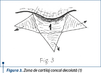 Figura 3. Zona de cartilaj concal decolată (1)