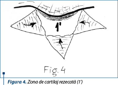 Figura 4. Zona de cartilaj rezecată (1’)