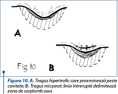 Figura 10. A. Tragus hipertrofic care proeminează peste cavitate; B. Tragus micşorat; linia întreruptă delimitează zona de surplomb osos