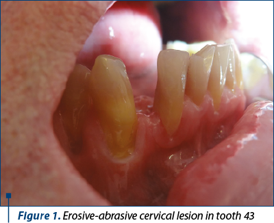 Figure 1. Erosive-abrasive cervical lesion in tooth 43