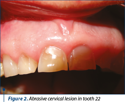 Figure 2. Abrasive cervical lesion in tooth 22