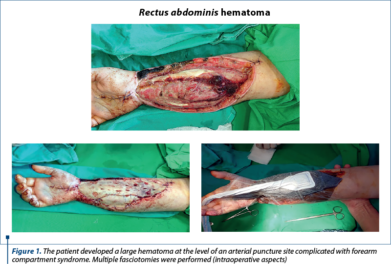 Figure 1. The patient developed a large hematoma at the level of an arterial puncture site complicated with forearm compartment syndrome. Multiple fasciotomies were performed (intraoperative aspects)