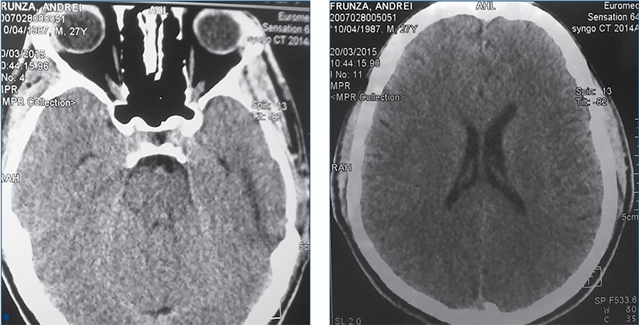 Figura 5. Sector de atrofie în lobul temporal stâng, lipsa semnelor de abces și edem cerebral