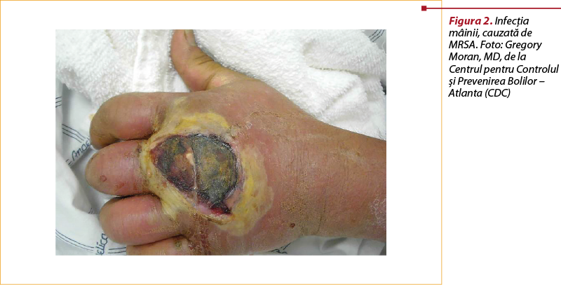 Figura 2. Infecţia mâinii, cauzată de MRSA. Foto: Gregory Moran, MD, de la Centrul pentru Controlul şi Prevenirea Bolilor – Atlanta (CDC)