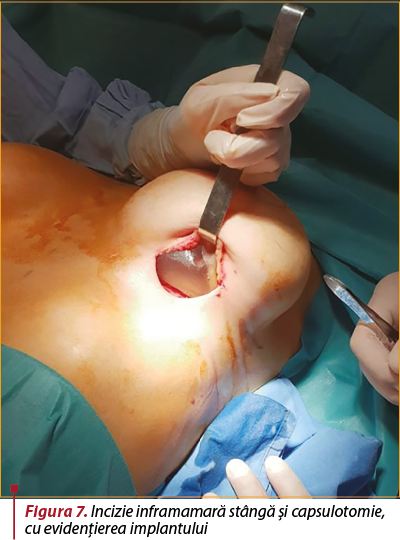 Figura 7. Incizie inframamară stângă şi capsulotomie, cu evidenţierea implantului