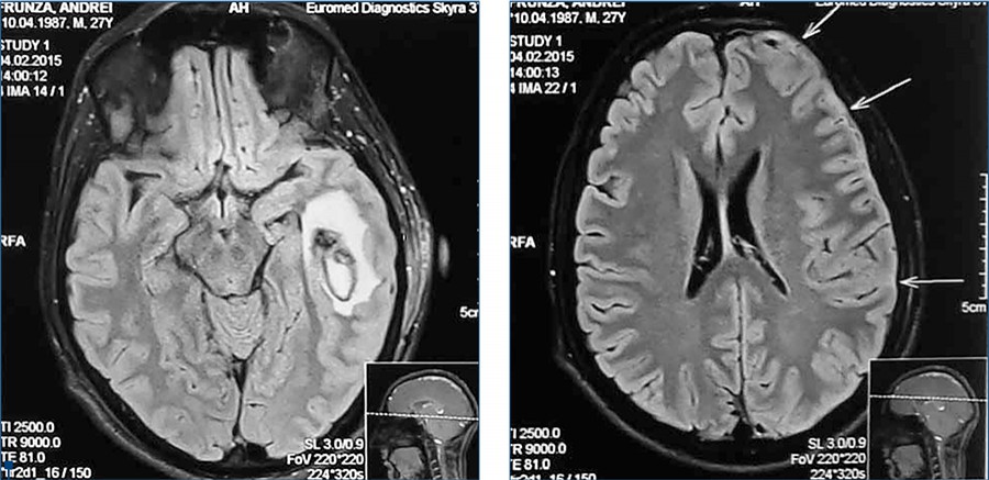 Figura 4. RMN - abces al lobului temporal stâng, menigoencefalită secundară, edem cerebral, deplasarea spre dreapta a liniei mediane