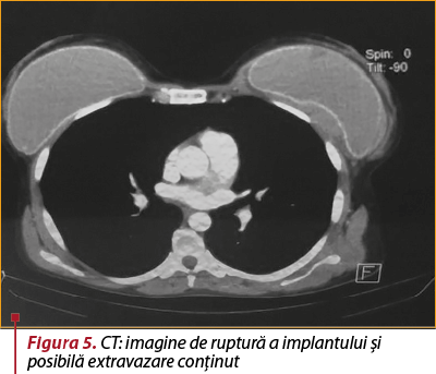 Figura 5. CT: imagine de ruptură a implantului şi posibilă extravazare conţinut