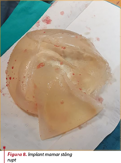 Figura 8. Implant mamar stâng  rupt