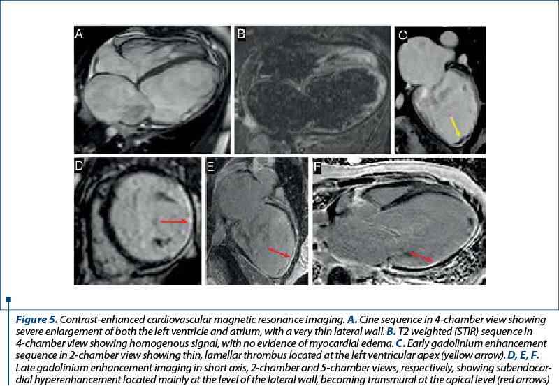 Figure 5. Contrast-enhanced cardiovascular magnetic resonance imaging. A. Cine sequence in 4-chamber view showing se­vere enlargement of both the left ventricle and atrium, with a very thin lateral wall. B. T2 weighted (STIR) sequence in 4-chamber view showing homogenous signal, with no evidence of myocardial edema. C. Early gadolinium enhancement se­quence in 2-chamber view showing thin, lamellar thrombus located at the left ventricular apex (yellow arrow). D, E, F. Late gadolinium enhancement imaging in short axis, 2-chamber and 5-chamber views, respectively, showing sub­en­do­car­dial hyperenhancement located mainly at the level of the lateral wall, becoming transmural at the apical level (red arrows)