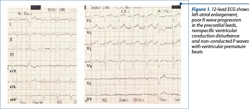 Figure 1. 12-lead ECG shows left atrial enlargement,  poor R wave progression in the precordial leads, nonspecific ventricular conduction dis­tur­bance  and non-con­duc­ted P waves with ven­tri­cular premature beats
