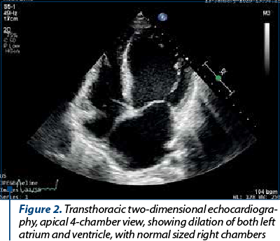 Figure 2. Transthoracic two-dimensional echocardio­gra­phy, apical 4-chamber view, showing dilation of both left atrium and ventricle, with normal sized right chambers