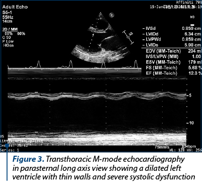 Figure 3. Transthoracic M-mode echocardiography in parasternal long axis view showing a dilated left ventricle with thin walls and severe systolic dysfunction