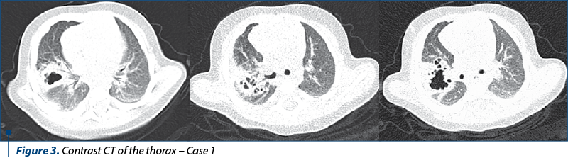Figure 3 Figure 3. Contrast CT of the thorax – Case 1