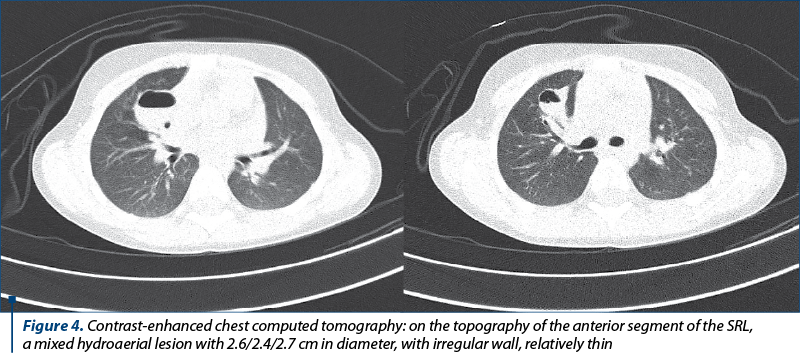 Figure 4. Contrast-enhanced chest computed tomography: on the topography of the anterior segment of the SRL,  a mixed hydroaerial lesion with 2.6/2.4/2.7 cm in diameter, with irregular wall, relatively thin