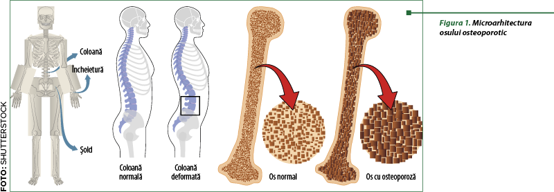 Figura 1. Microarhitectura  osului osteoporotic