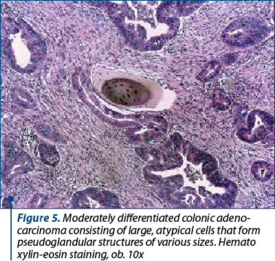 Figure 5. Moderately differentiated colonic ade­no­car­ci­noma consisting of large, atypical cells that form pseudoglandular structures of various sizes. He­ma­to­xylin-eosin staining, ob. 10x