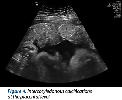 Figure 4. Intercotyledonous calcifications  at the placental level
