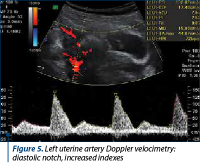 Figure 5. Left uterine artery Doppler velocimetry: diastolic notch, increased indexes