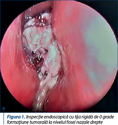 Figura 1. Inspecţie endoscopică cu tija rigidă de 0 grade –  formaţiune tumorală la nivelul fosei nazale drepte