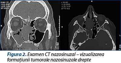 Figura 2. Examen CT nazosinuzal – vizualizarea formaţiunii tumorale nazosinuzale drepte