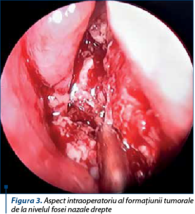 Figura 3. Aspect intraoperatoriu al formaţiunii tumorale de la nivelul fosei nazale drepte