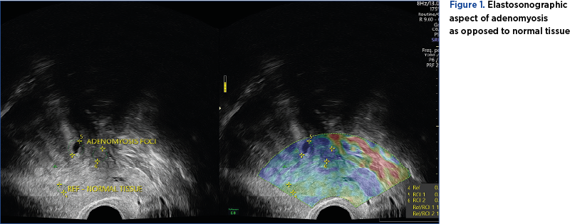 Figure 1. Elastosonographic aspect of adenomyosis  as opposed to normal tissue