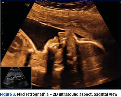 Figure 3. Mild retrognathia – 2D ultrasound aspect. Sagittal view