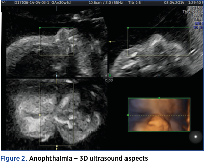 Figure 2. Anophthalmia – 3D ultrasound aspects