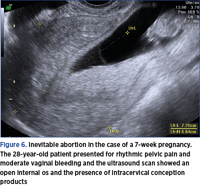 Figure 6. Inevitable abortion in the case of a 7-week pregnancy. The 28-year-old patient presented for rhythmic pelvic pain and moderate vaginal bleeding and the ultrasound scan showed an open internal os and the presence of intracervical conception products