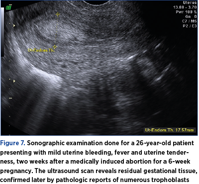Figure 7. Sonographic examination done for a 26-year-old patient presenting with mild uterine bleeding, fever and uterine tenderness, two weeks after a medically induced abortion for a 6-week pregnancy. The ultrasound scan reveals residual gestational tissue, confirmed later by pathologic reports of numerous trophoblasts