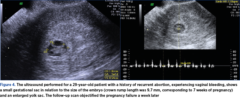 Figure 4. The ultrasound performed for a 29-year-old patient with a history of recurrent abortion, experiencing vaginal bleeding, shows a small gestational sac in relation to the size of the embryo (crown rump length was 9.7 mm, corresponding to 7 weeks of pregnancy) and an enlarged yolk sac. The follow-up scan objectified the pregnancy failure a week later