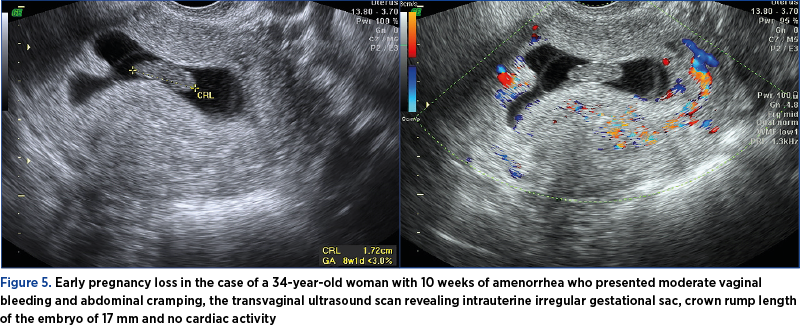 Figure 5. Early pregnancy loss in the case of a 34-year-old woman with 10 weeks of amenorrhea who presented moderate vaginal bleeding and abdominal cramping, the transvaginal ultrasound scan revealing intrauterine irregular gestational sac, crown rump length of the embryo of 17 mm and no cardiac activity