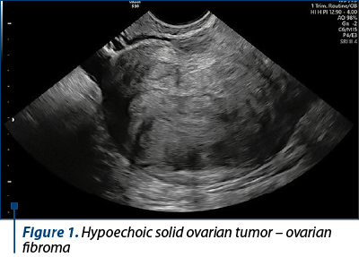 Figure 1. Hypoechoic solid ovarian tumor – ovarian fibroma