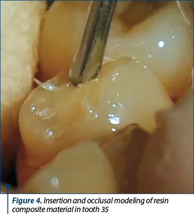 Figure 4. Insertion and occlusal modeling of resin composite material in tooth 35