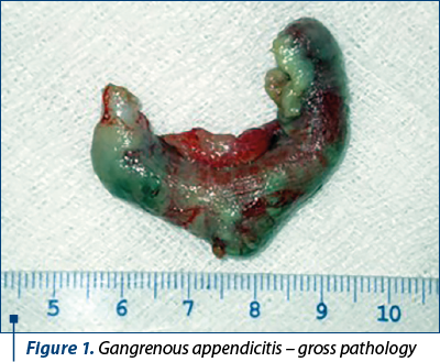Figure 1. Gangrenous appendicitis – gross pathology