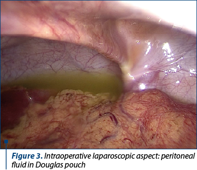 Figure 3. Intraoperative laparoscopic aspect: peritoneal fluid in Douglas pouch