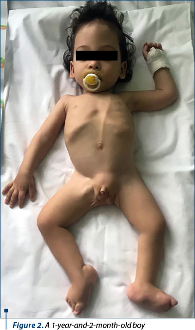 Figure 2. A 1-year-and-2-month-old boy  
