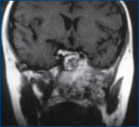 Figura 2. RM cerebral (secţiune coronală) - extensia leziunii în sinusul cavernos