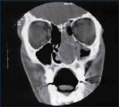 Figura 1. CT cerebral (incidenţă coronală) - formaţiune tumorală care ocupă fosa nazală stângă şi ce